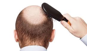 شایع ترین علت ریزش مو را بشناسید
