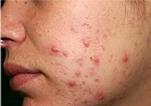 خوراکی‌های ماه رمضانی که دشمن پوست شما می‌شوند