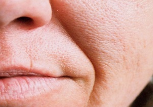راهکار‌های آسان و خانگی برای از بین بردن خط خنده/ مثلث سلامت را فراموش نکنید