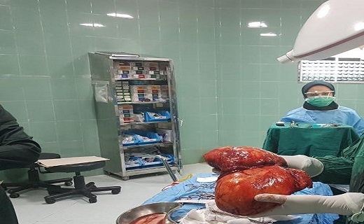توده‌ای ۵ کیلوگرمی از کلیه بانوی چهل ساله چابهاری خارج شد+ عکس