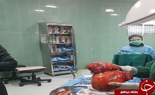 توده&zwnj;ای ۵ کیلوگرمی از کلیه بانوی چهل ساله چابهاری خارج شد+ عکس