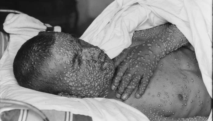۵ نمونه سلاح بیولوژیکی که از بمب اتم خطرناک&zwnj;تر خواهند بود