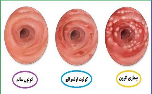 پوست این میوه را دور نریزید/ به این دلایل زخم روده می گیرید/ به جای آسانسور از پله استفاده کنید/ افزایش حافظه با این خوراکی خوشمزه