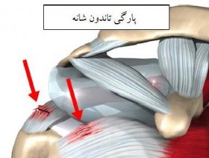 علائم پارگی تاندون شانه چیست؟ + درمان