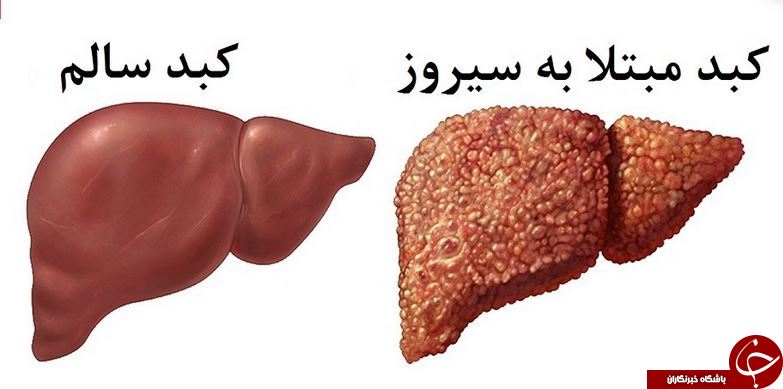 بیماری سیروز کبدی چیست و چه درمانی دارد؟ بیماری سیروز کبدی چیست و چه درمانی دارد؟