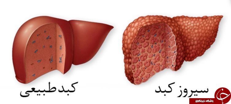 بیماری سیروز کبدی چیست و چه درمانی دارد؟ بیماری سیروز کبدی چیست و چه درمانی دارد؟