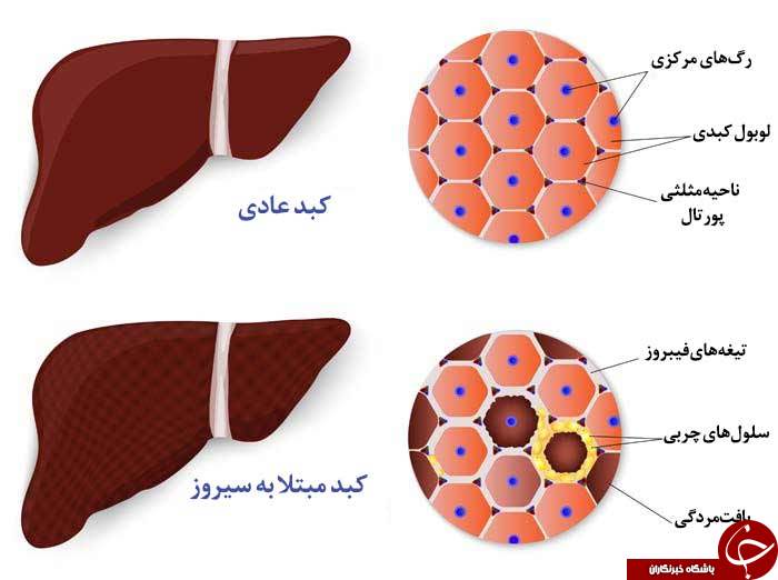 بیماری سیروز کبدی چیست و چه درمانی دارد؟ بیماری سیروز کبدی چیست و چه درمانی دارد؟