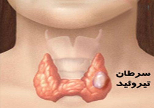 تیروئید بیماری پیدا یاپنهان