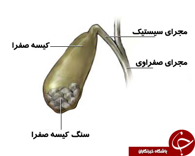 چرا وجود کیسه صفرا در بدن ضروری نیست؟
