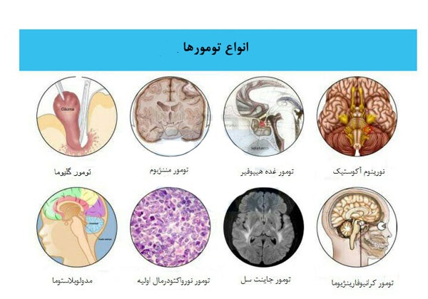 تومور&zwnj;هایی که در سرتان جا خوش می&zwnj;کنند/ زنگ خطر&zwnj;هایی که از تومور&zwnj;های مغزی خبر می&zwnj;دهند
