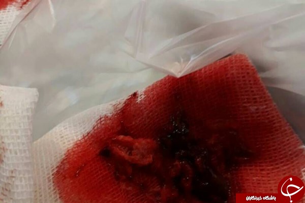 ماجرای جا ماندن &laquo;گاز پانسمان&raquo; در بدن بیمار چه بود؟+ تصاویر