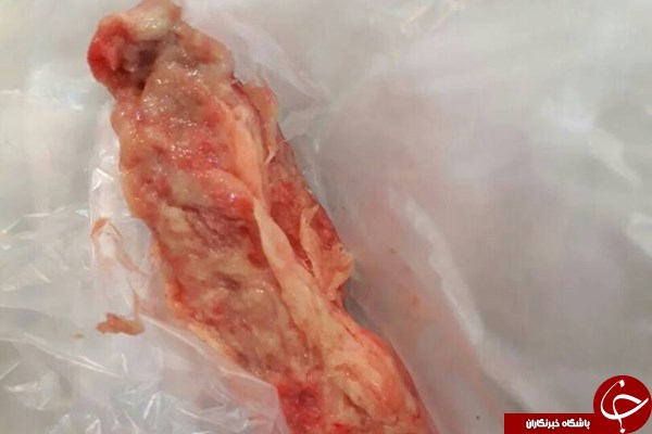ماجرای جا ماندن &laquo;گاز پانسمان&raquo; در بدن بیمار چه بود؟+ تصاویر