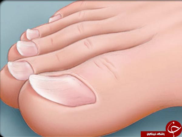 آیا وضو گرفتن در صورتی که یکی از ناخن های پا لاک نداشته باشد مشکل شرعی دارد؟