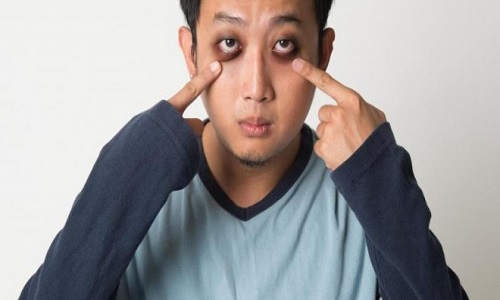 راهکاری برای از بین بردن پف چشم