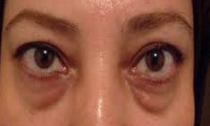 ترفندهایی برای از بین بردن پف زیر چشم