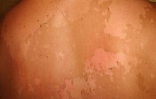 آفتاب سوختگی را چگونه درمان کنیم؟ آفتاب سوختگی را چگونه درمان کنیم؟