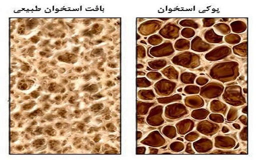 اثر کمبود کلسیم در زنان/ سرطانی که کودکان را درگیر می کند/ بیماری عفونی کارگران اثر کمبود کلسیم در زنان/ سرطانی که کودکان را درگیر می کند/ بیماری عفونی کارگران