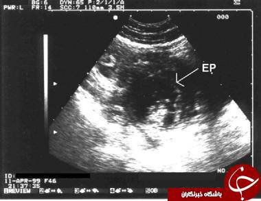 بهترین روش تشخیص حاملگی+ مهم ترین علائم بارداری