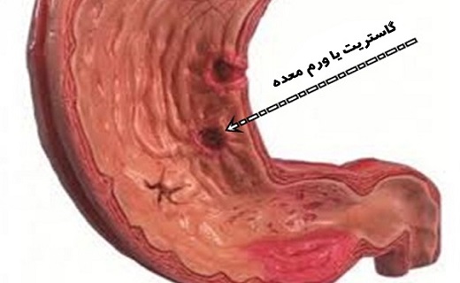 دانه تلخ زردآلو را نخورید&nbsp;/ بدترین شکستگی ها کدام است/ خطر دود کباب برای سلامتی/ نمک هایی که برای سلامتی مضر اند