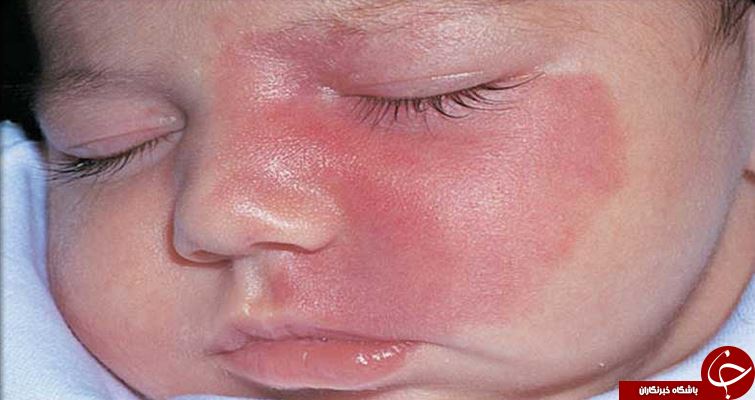 ماه گرفتگی چگونه بر روی پوست ایجاد می&zwnj;شود؟ +انواع آن / ماه گرفتگی بر روی پوست و انواع آن