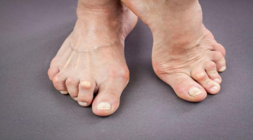 آیا بیماری نقرس یک بیماری ارثی ست؟