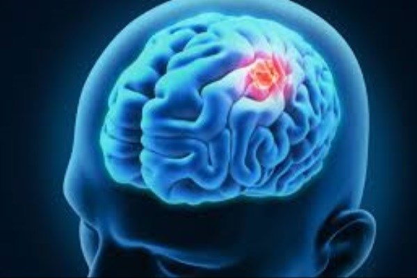 مقابله با سرطان مغز با استفاده از درمان ویروس فلج اطفال