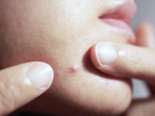 5 ضایعه پوستی که هرگز نباید آن را دستکاری کنید