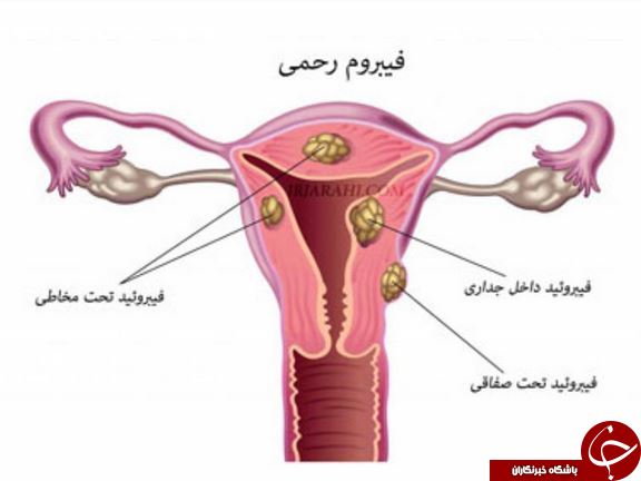 از فیبروم رحمی چه می&zwnj;دانید؟! + علائم، انواع و راه&zwnj;های درمان / فیبروم چه نشانه&zwnj;هایی دارد؟