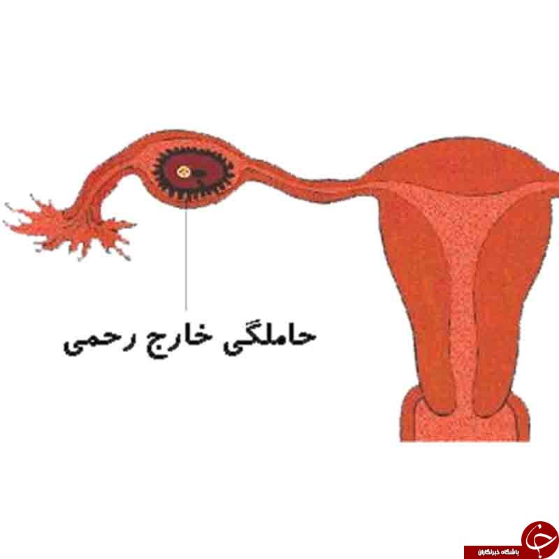 همه آنچه درباره حاملگی خارج از رحم باید بدانید + علائم و نحوه پیشگیری
