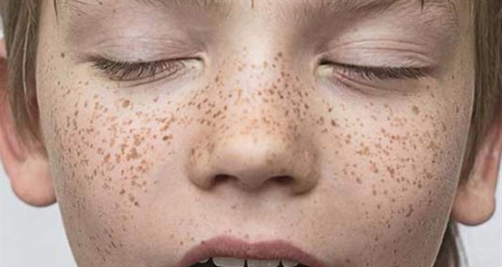 چگونه با کک و مک‌های تابستانی مقابله کنیم؟