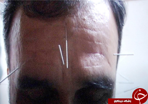 طب سوزی، طب بدون عارضه / استقبال مردم از طب سوزنی روز به روز بیشتر می&zwnj;شود + تصاویر
