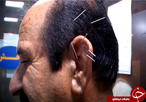 طب سوزی، طب بدون عارضه / استقبال مردم از طب سوزنی روز به روز بیشتر می&zwnj;شود + تصاویر