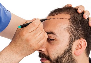 آیا با کاشت می&zwnj;توان به موهای پرپشت دست پیدا کرد؟