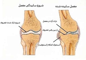 درد مهمترین نشانه بیماری آرتروز