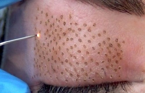پوستی شاداب و جوان با پیوند سلول&zwnj;های فیبروبلاست