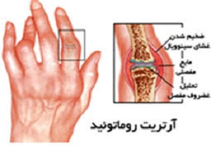 آرتریت روماتوئید چه بیماری است