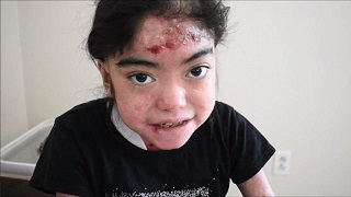 دختری که هر روز پوست بدنش می ریزد+ فیلم