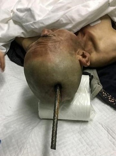 زنده ماندن کارگر ساختمانی پس از فرو رفتن میلگرد در جمجمه اش! +تصاویر