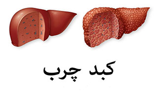 خطر کبد چرب در کمین شماست + فیلم