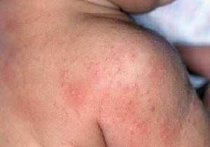 راه های مبارزه با عرق سوختگی نوزادان