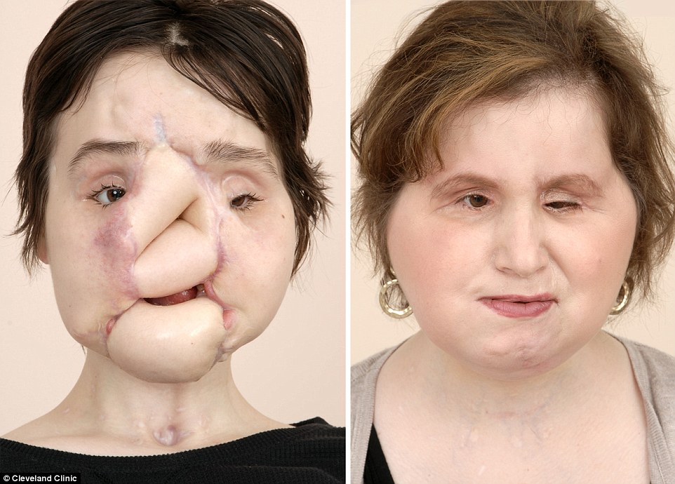 عمل پیوند صورت، دختر جوان را به زندگی عادی برگرداند + فیلم