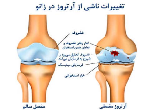 آرتروز یا ساییدگی مفاصل، بیماری شایع