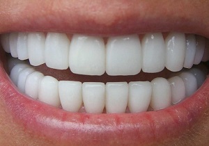 فرمول&zwnj;های معجزه آسای طب سنتی برای سفید کردن دندان&zwnj;ها