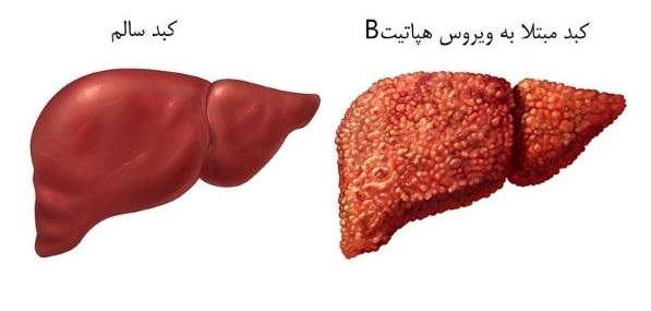 //////////////////////برزگری/////////////////////موفقیت کلینیکی درمان مکمل هپاتیت با ازن&zwnj;تراپی/ ازن&zwnj;تراپی بهترین پاسخ را روی 15 بیمار داوطلب