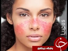 بیماری لوپوس چه نوع بیماری ای است؟