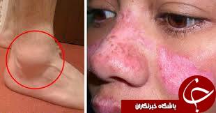 بیماری لوپوس چه نوع بیماری ای است؟