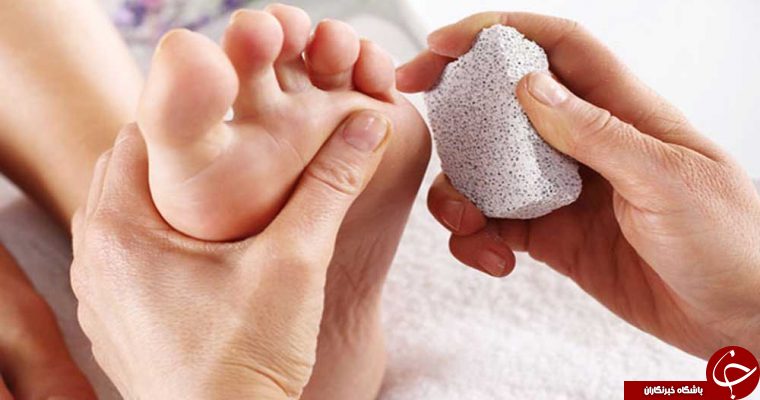 برای درمان میخچه چه کاری بکنیم ؟