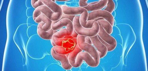 سلامت روده&zwnj;تان را به دست این میوه شفابخش بسپارید!