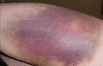 کیمیاگری درمانی؛ تبدیل زخم باز به پوست