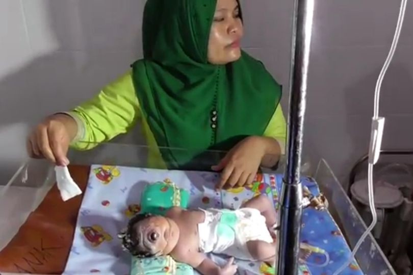 تولد نوزاد تک چشم در اندونزی! +فیلم (+16)